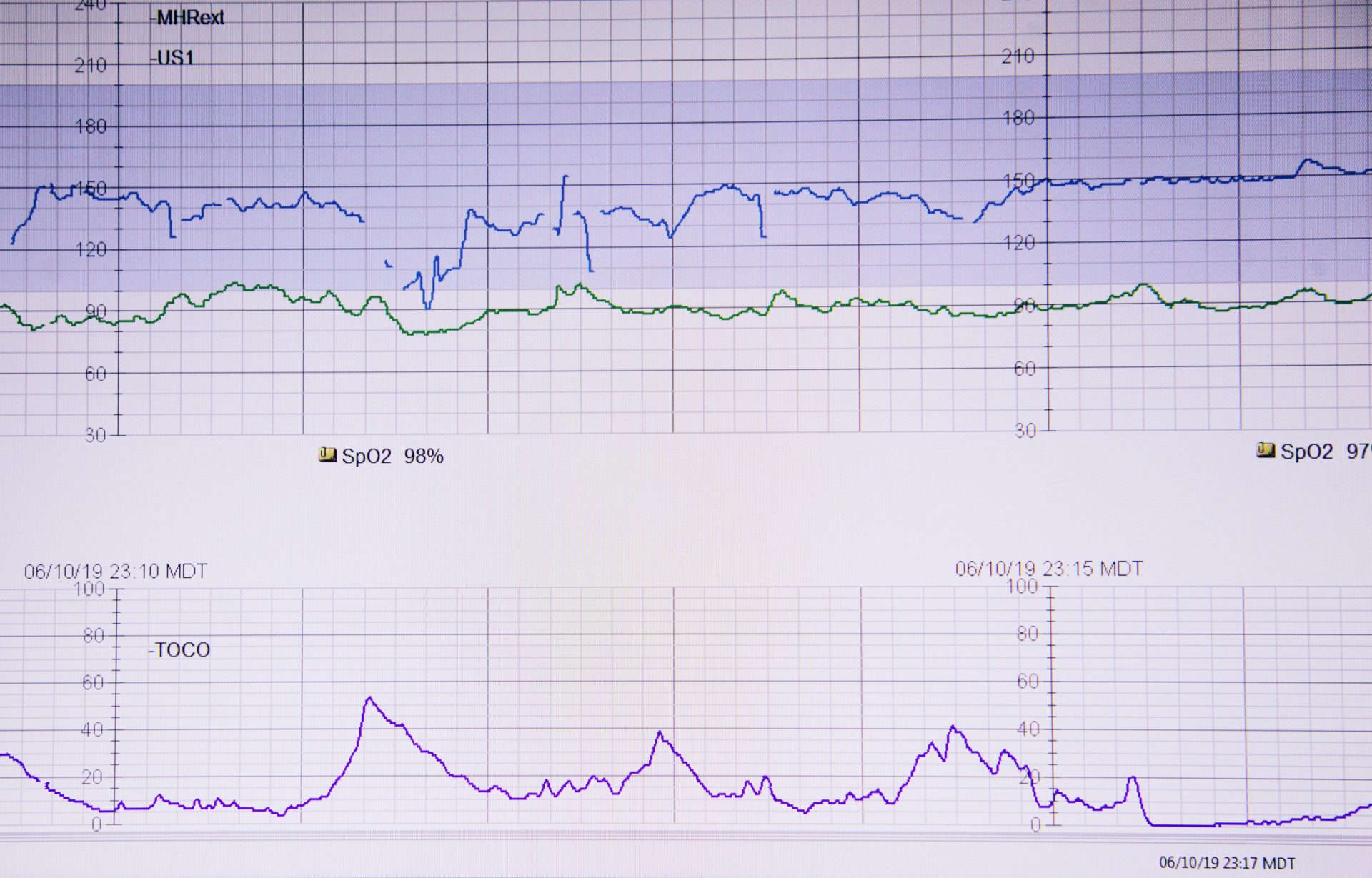 hospital heartbeat graph
